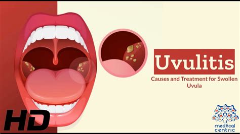 Uvulitis Explained: What's Causing Your Swollen Uvula? - YouTube