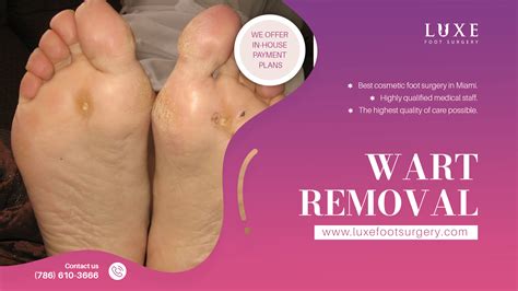 Affordable Plantar Wart Removal in Miami Starting at $500