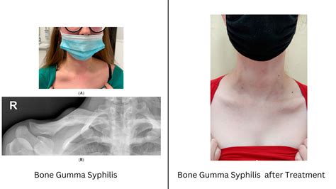 Syphilis Gumma: Pictures, Symptoms, Diagnosis, and Prevention - STD Testing Near Me