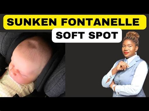 Causes and Treatment of a Sunken Fontanel and Soft Spot | Fontanelle ...