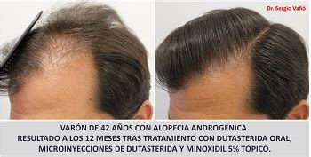 Dutasteride and Minoxidil Before and After Photos | Hair Loss Cure 2020