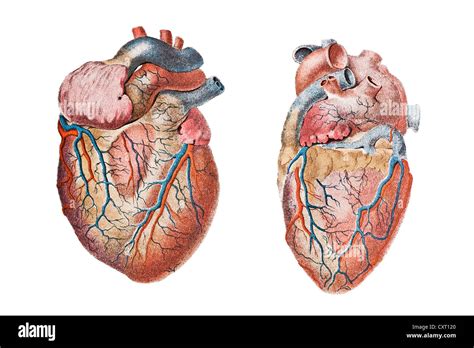 Unhealthy Heart Diagram