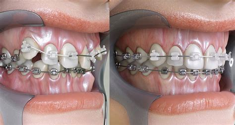 How To Fix A Misaligned or crooked Jaw?