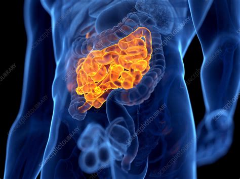 Cancer of the small intestine, illustration - Stock Image - F034/9924 ...