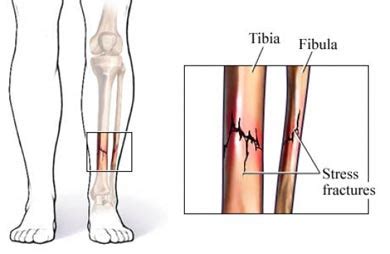 Stress Fracture - PT & ME