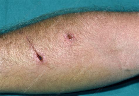 The wound of a dog bite one week after the injury - Stock Image - M330/0262 - Science Photo Library