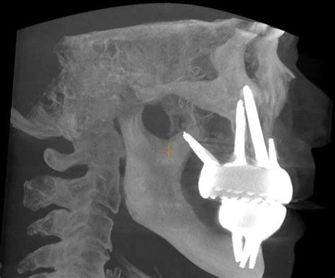 Zygomatic Implants In New York - Dr Kaplansky