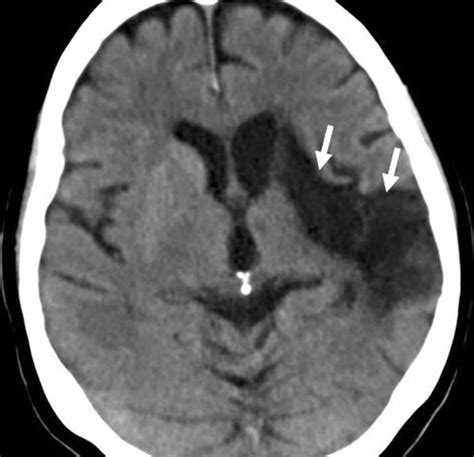 Stroke Ct Scan