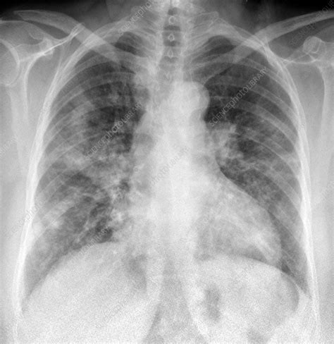 Bacterial Pneumonia Chest X Ray