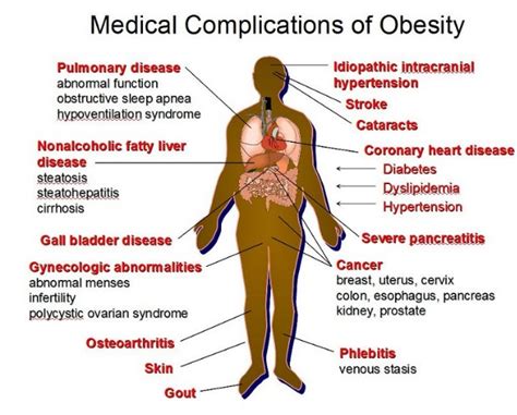 The 20 Medical Complications of Obesity - Health Issues Solution