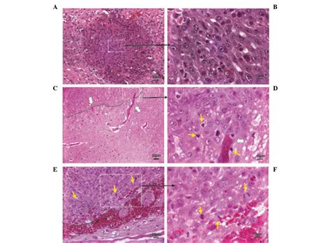 Characterization of highly proliferative secondary tumor clusters along ...