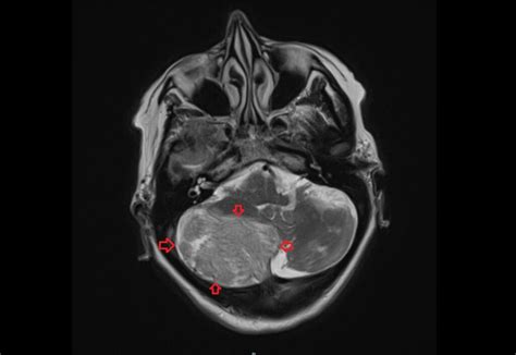 MRI Dysplastic cerebellar gangliocytoma (Lhermitte-Duclos disease)