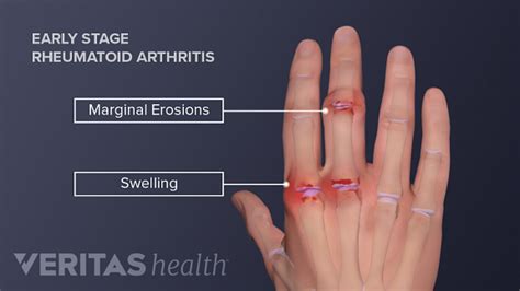 Hand Pain and Rheumatoid Arthritis