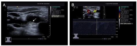 Frontiers | Sitosterolemia With Atherosclerosis in a Child: A Case Report