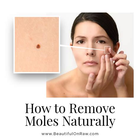 Skin Moles … Removal and Prevention | Beautiful on Raw | Skin moles, Moles on face, Mole removal