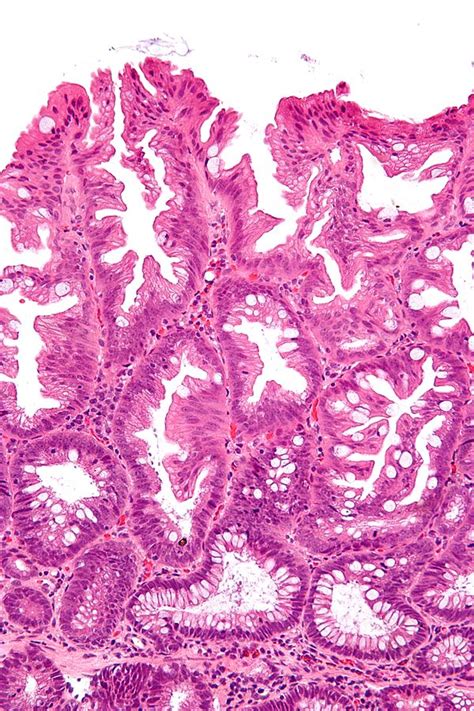 Sessile serrated adenoma - Libre Pathology