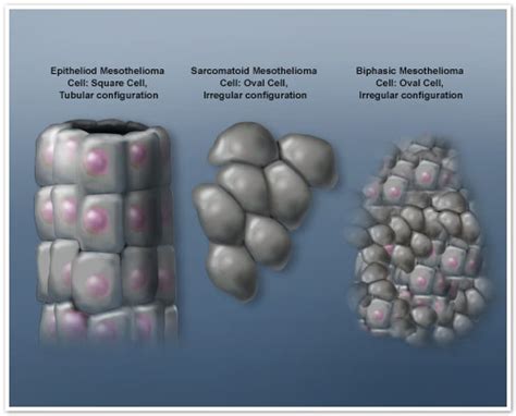 Mesothelioma Types - Pericardial, Pleural, and Peritoneal