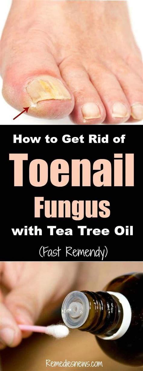 How to Get Rid of Toenail Fungus with Tea Tree Oil (Fast Remedy): Here are some home remedies to ...