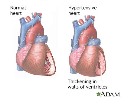 Hypertensive heart disease Information | Mount Sinai - New York