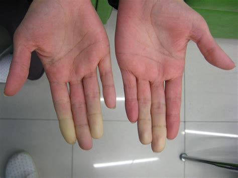 File:Secondary Raynaud's in Sjögren's syndrome 1.JPG - Wikimedia Commons