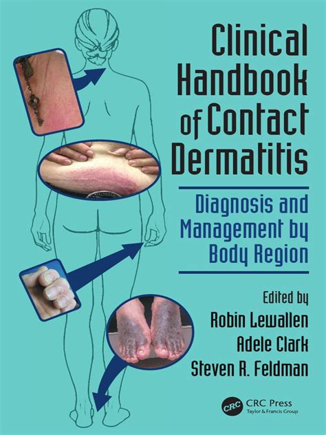 Clinical Handbook of Contact Dermatitis - Diagnosis and Management by ...