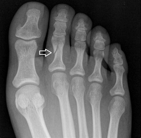 Diagnosis and Management of Common Foot Fractures | AAFP