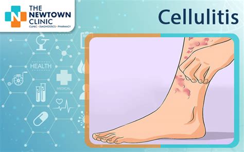 Cellulitis - Symptoms and Causes - The Newtown Clinic