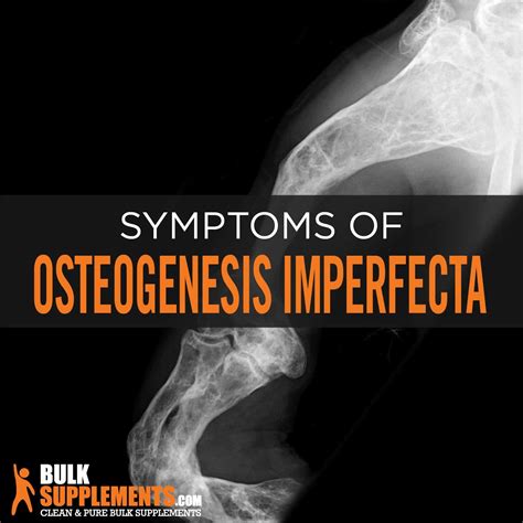 Osteogenesis Imperfecta (OI): Symptoms, Causes & Treatment