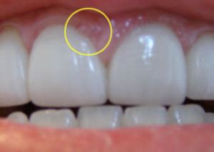 Pimple on Gums - Pictures, Causes, Prevention & Home Remedy