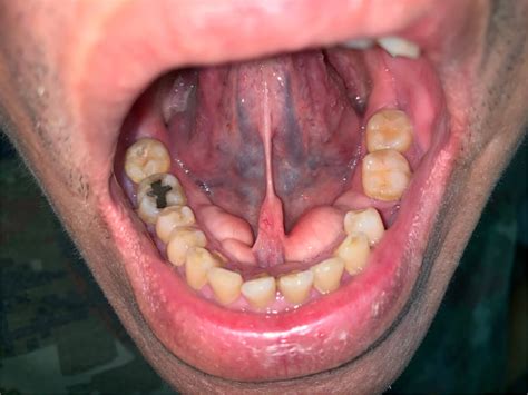 Common Symptoms of Gingival Hyperplasia | rockville-all-smiles-dentistry