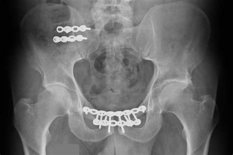 Pelvic fractures