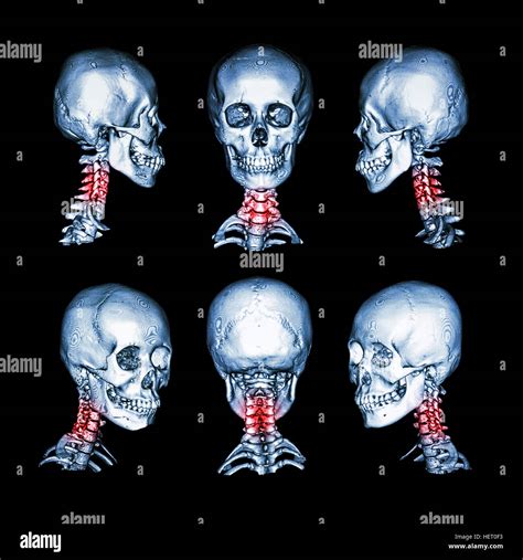 Ankylosing spondylitis xray hi-res stock photography and images - Alamy