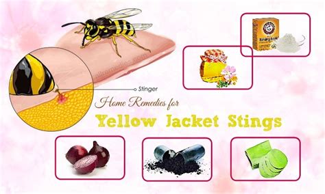 13 Best Home Remedies For Yellow Jacket Stings And Swelling