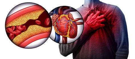 Mild Heart Attack: How Serious Is It? Know Treatment | Dr. C Raghu