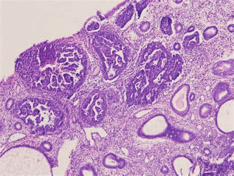 Endometrial poorly differentiated serous adenocarcinoma of the uterus ...