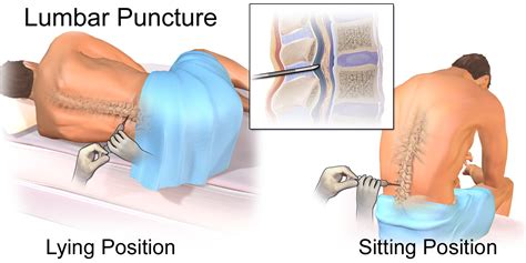 Lumbar Puncture Diagram