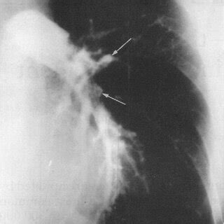 Figure Pulmonary angiogram obtained using a pulmonary artery catheter.... | Download Scientific ...