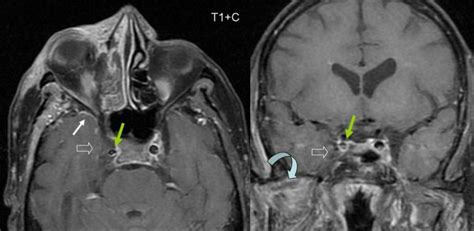 Cavernous Sinus Thrombosis - radRounds Radiology Network