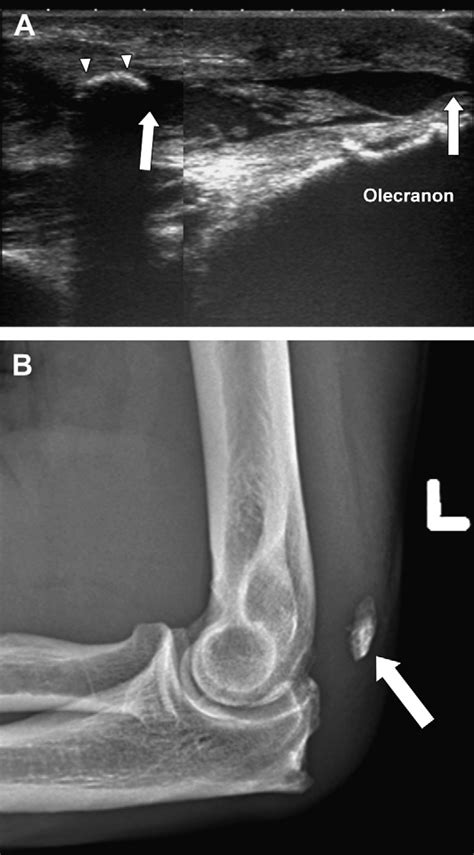 Distal triceps tendon tear. (A) Longitudinal image of the distal... | Download Scientific Diagram