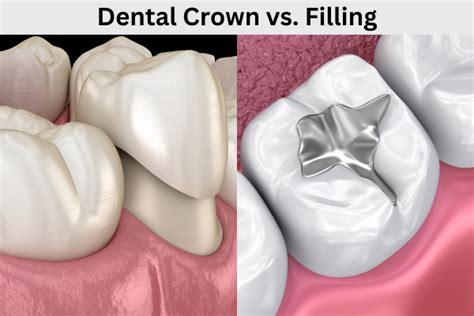 Dental Crown vs. Filling: Difference, Factors, Pros & Cons