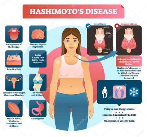 Hashimotos tiroiditis vector ilustración. Diagrama médico etiquetado. 2024