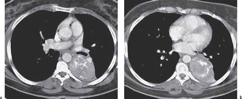 Tumors and Tumor-Like Lesions of the Lung | Radiology Key