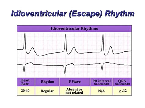 Ventricular Rhythms - BMH/Tele