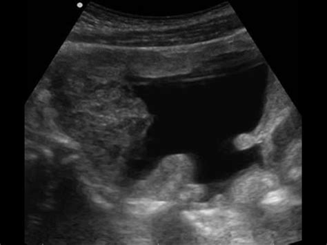 Urinary Tract and male reproductive system | 2.2 Bladder : Case 2.2.3 Miscellaneous bladder and ...