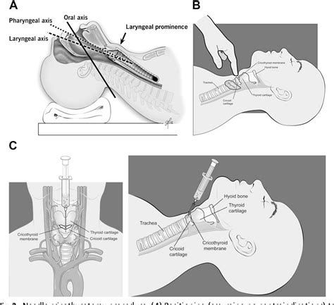 Figure 2 from Needle cricothyrotomy. | Semantic Scholar