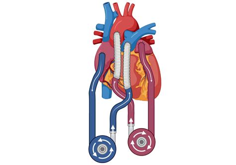 Biventricular assist device (BiVAD) | BioRender Science Templates