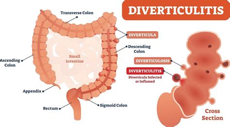 Understanding Diverticulitis: Symptoms & Treatment | Performance Health