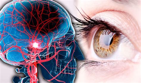 Stroke symptoms: Signs include reduced vision field - eye risk revealed ...