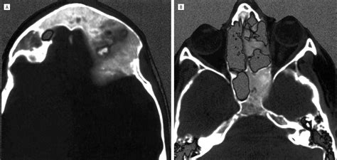 Fibrous Dysplasia Involving the Skull Base and Temporal Bone | Headache | JAMA Otolaryngology ...