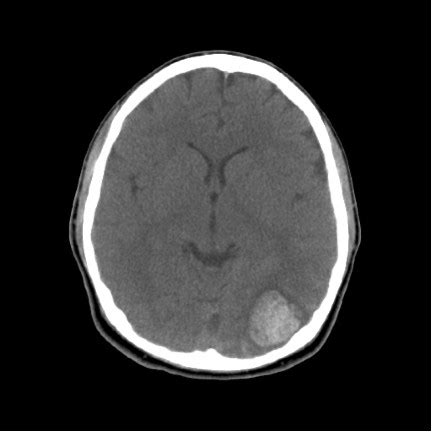 Ct Scan Brain Anuresym